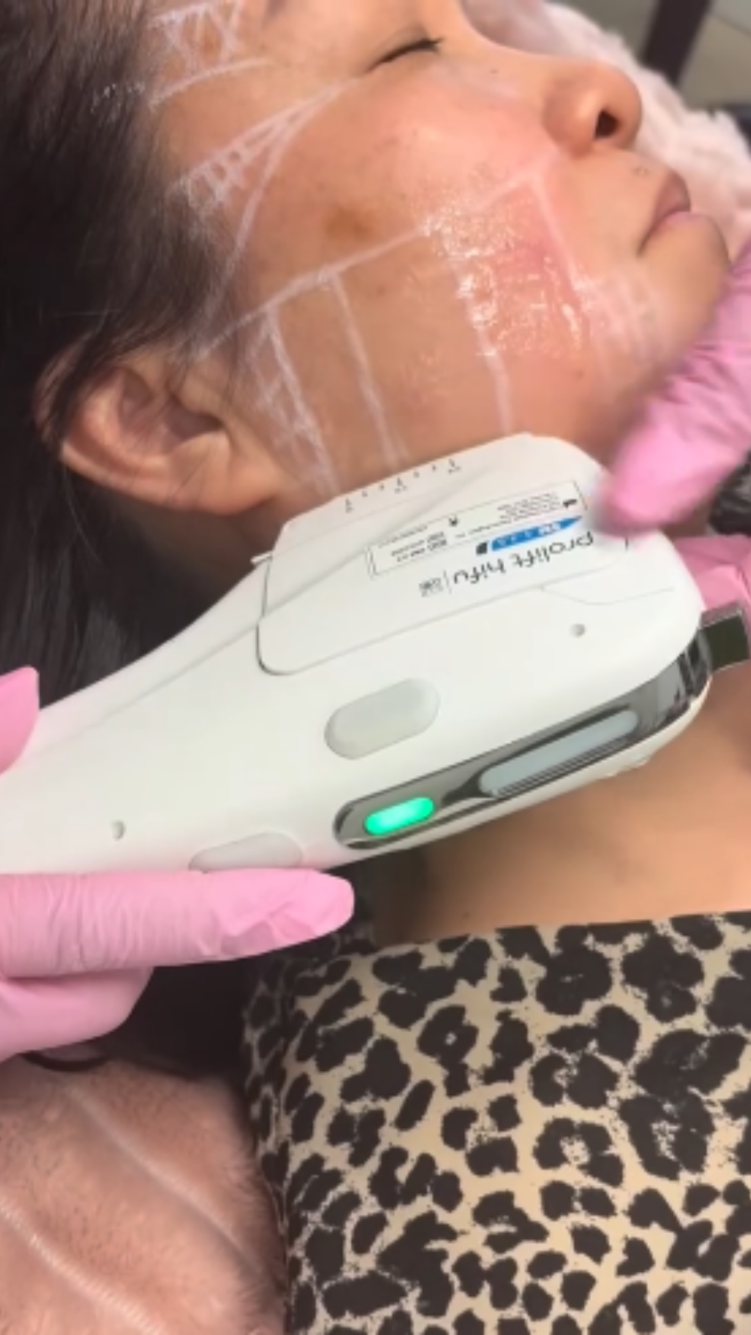 Prolift Dual treatment