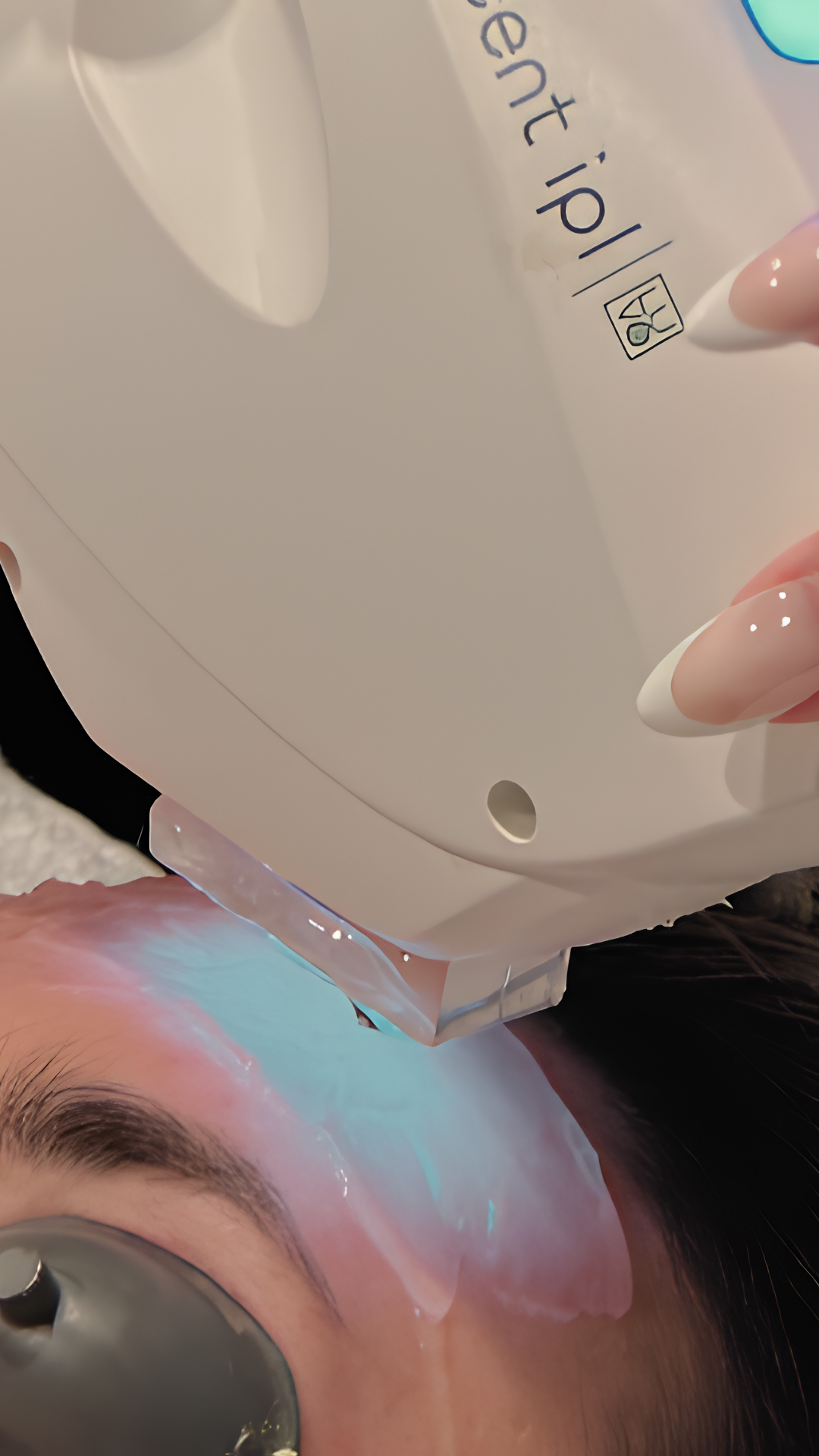 Lucent IPL treatment