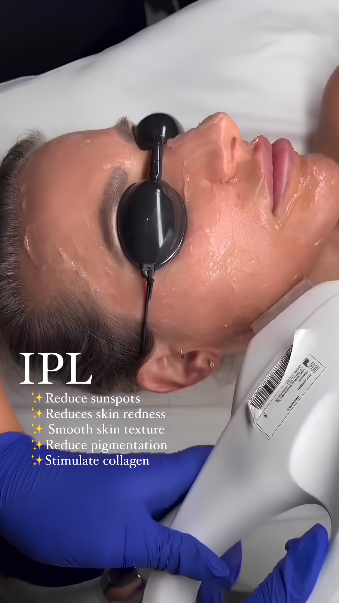 Lucent IPL treatment