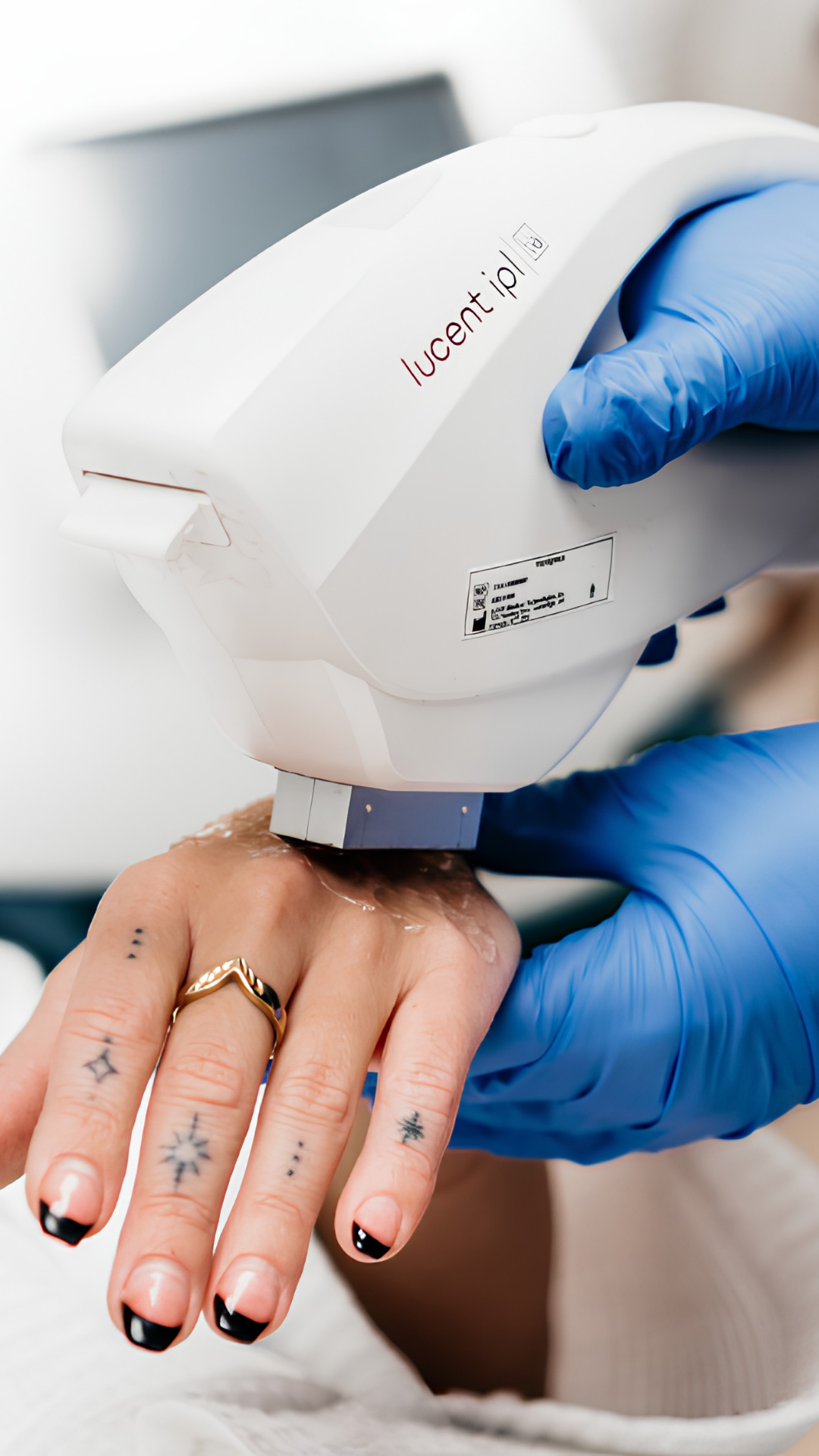 Lucent IPL treatment