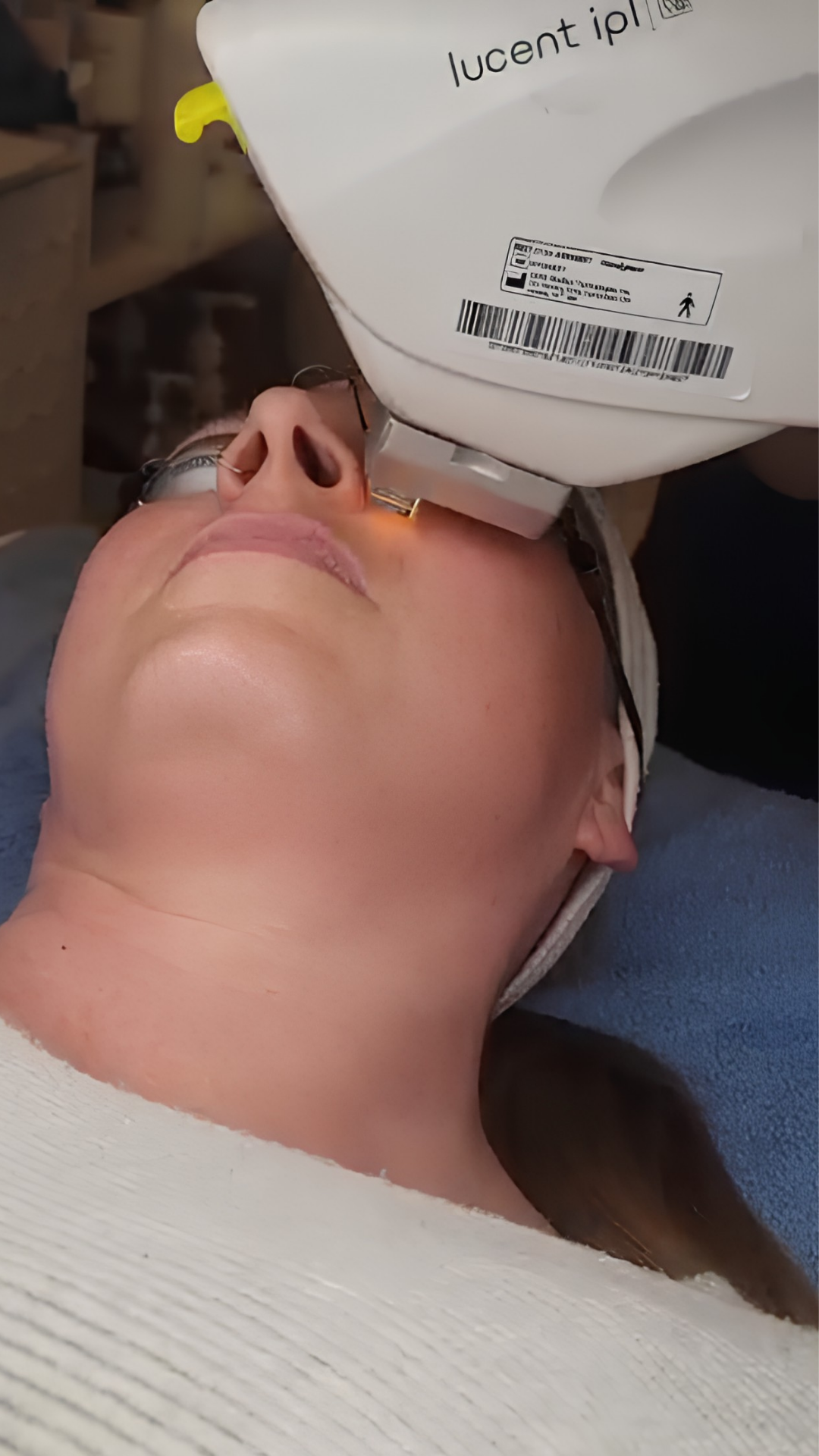 Lucent IPL treatment