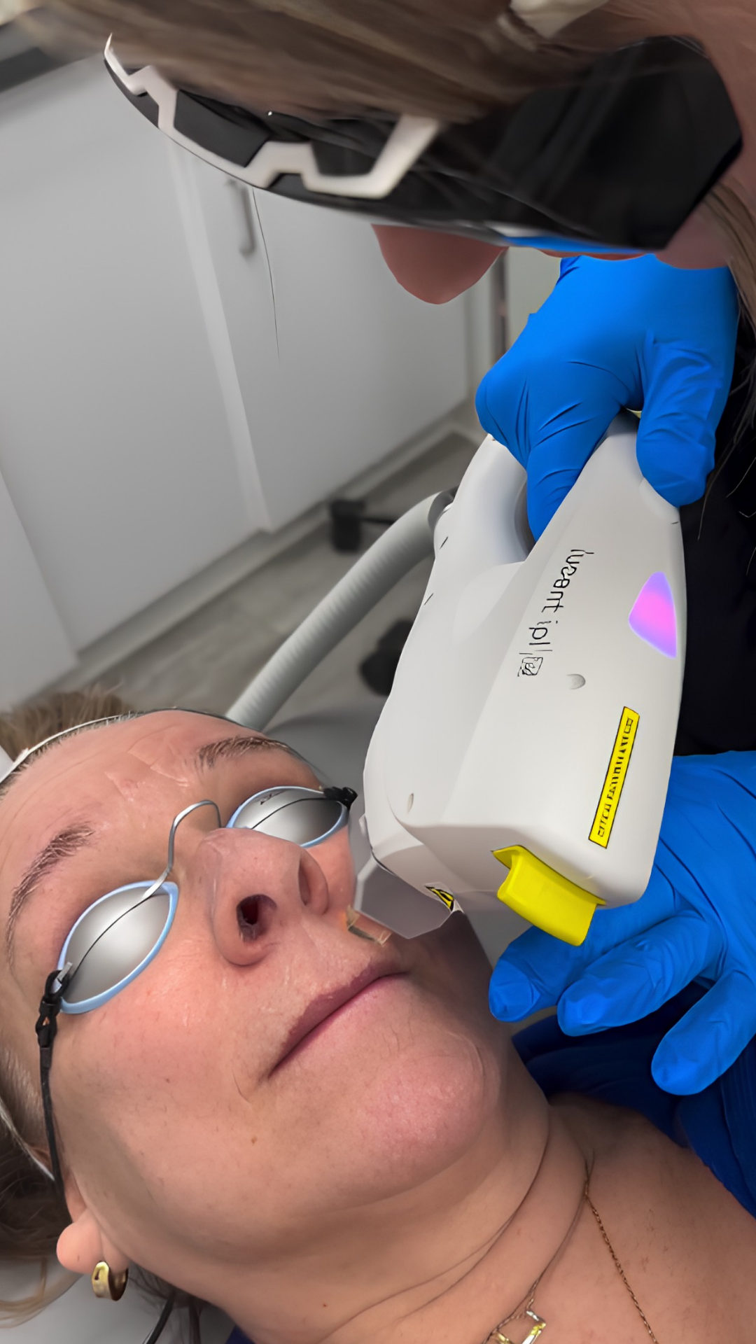 Lucent IPL treatment