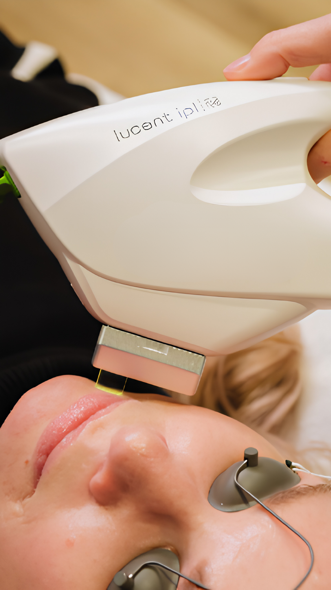 Lucent IPL treatment